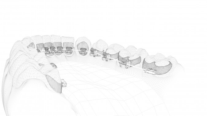 orthodontie lingual, invisible, esthétique, adultes, harmony, incognito