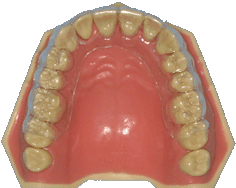orthodontie, orthodontiste, contention, amovible, gouttière, aligneurs