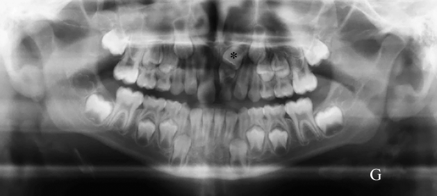 panoramique, orthodontie, inclusion 21