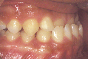 orthodontie orthopédie dento-faciale promandibulie