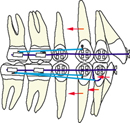 orthodontie, appareil multi-attaches, appareil multi-bagues, étapes, étapes 3