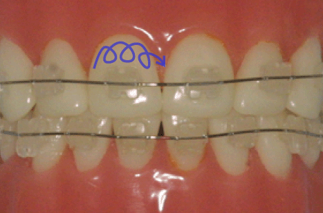 orthodontie, bagues, attaches, brackets, brossage, technique