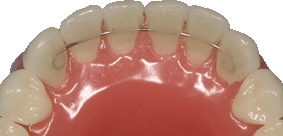 Résultat de recherche d'images pour "contention orthodontique"
